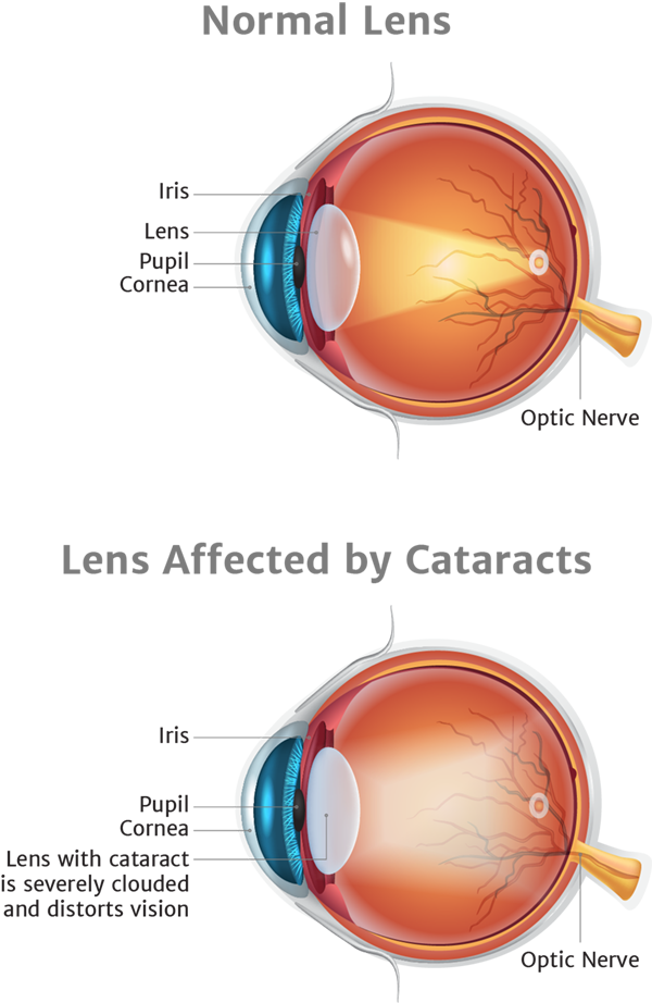 Illustration of lens affected by cataracts
